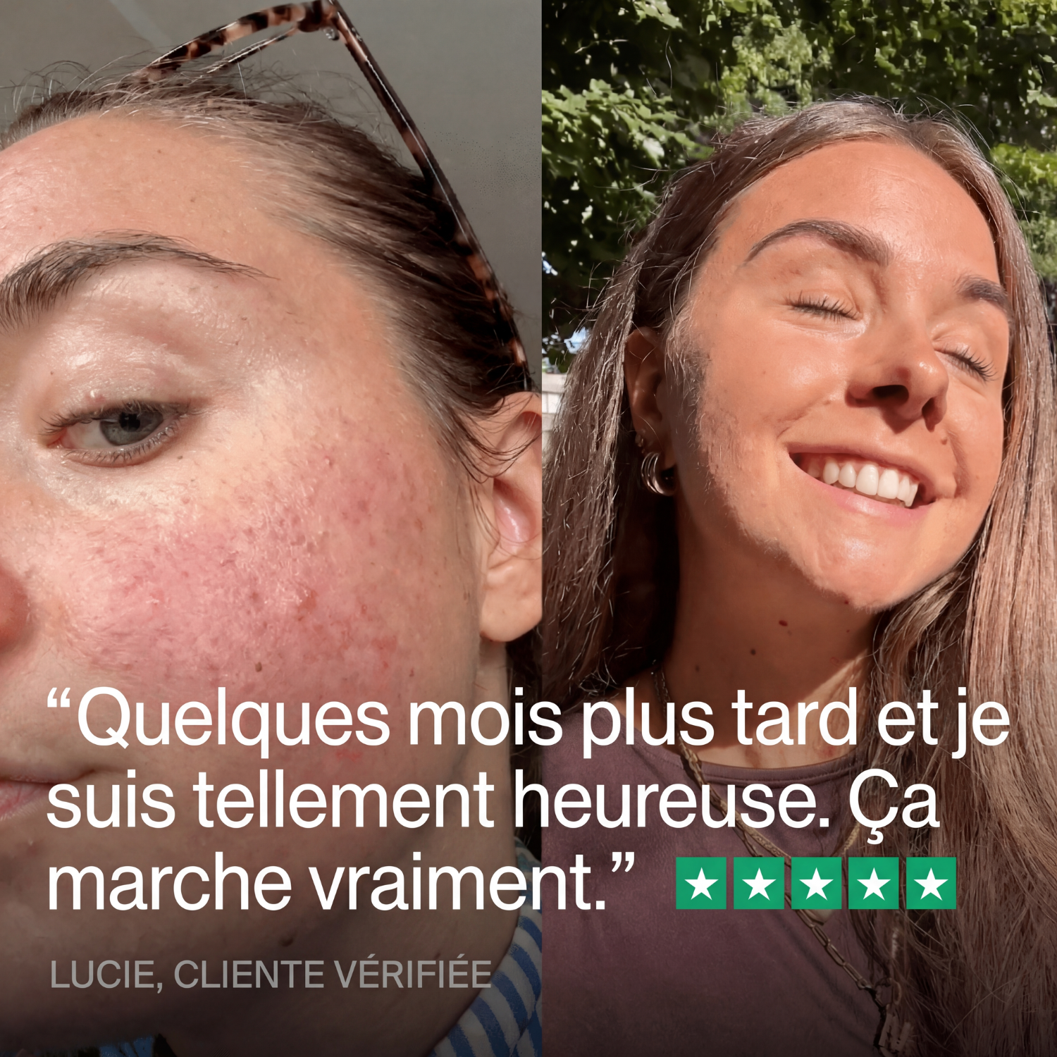 Élimine l'acné, de l'intérieur. Clera