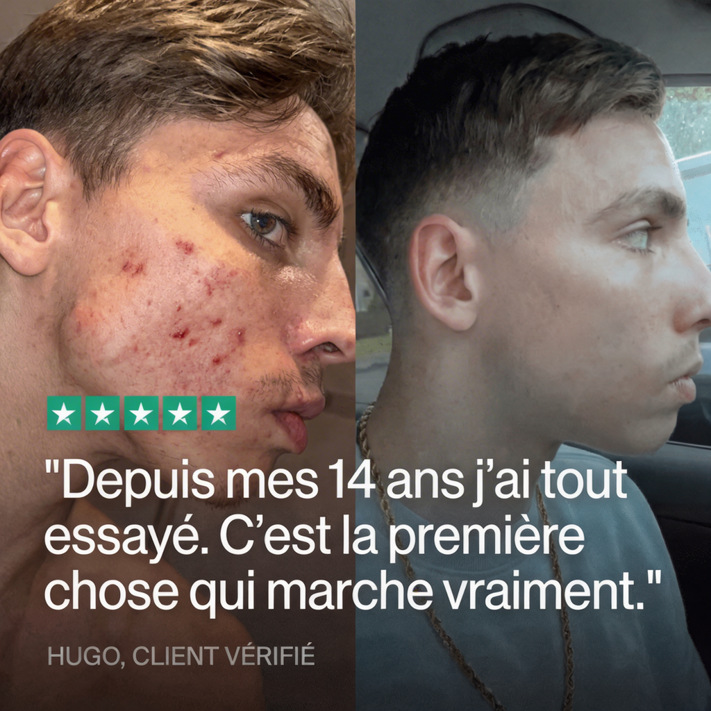 Élimine l'acné, de l'intérieur. Clera